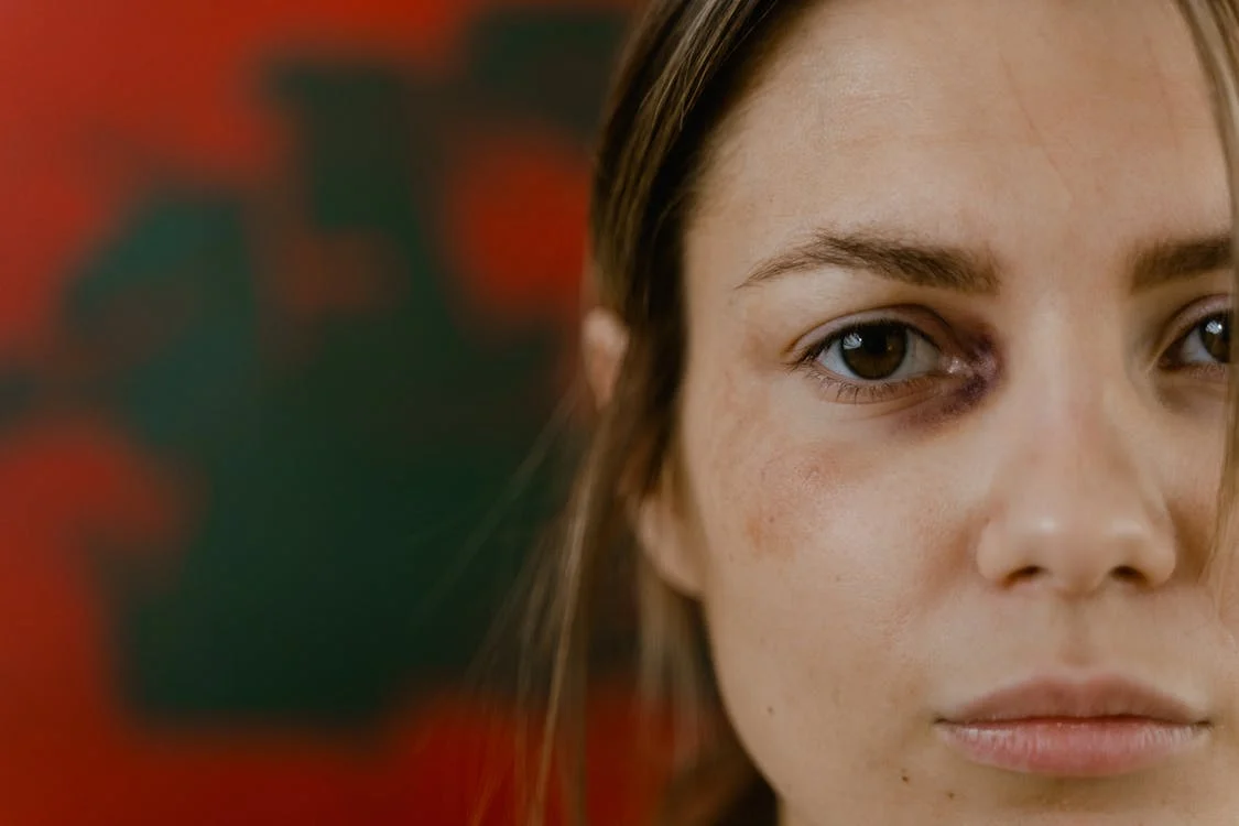 close-up shot-of-woman-with-black-eye close-up shot of woman with black eye